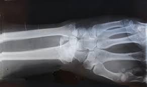 X-Ray of Left Arm Wrist Bones